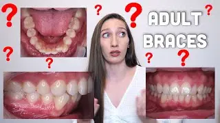 6 Reasons Why I Chose to get Braces as an Adult and my Adult Braces Progress so Far