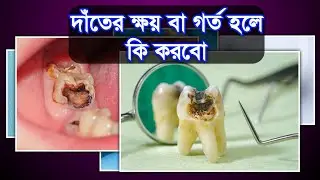 দাঁতের ক্ষয় বা গর্ত || Tooth cavities || Dental Health tips