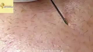 BIG Blackheads Removal   Acne Treatment   SPA ASMG   Blackheads on face