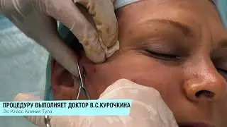 Тредлифтинг или подтяжка лица нитями-что это?