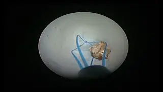 Improvisation de Panier au cours de la chirurgie rénale percutanée