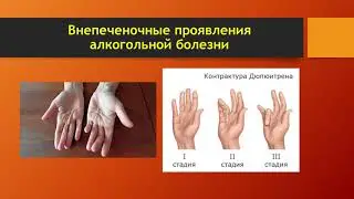 Заболевания печени 2 часть