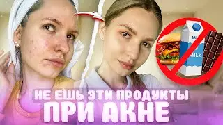 ПИТАНИЕ ПРИ ПРЫЩАХ | КАК ИЗБАВИТЬСЯ ОТ АКНЕ