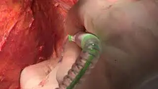 Mastectomy and Axillary Lymph Node Dissection