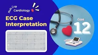 ECG Case Interpretation | Collapse | Mobitz II heart block | Bradycardia | Abnormal ECG | Case 12
