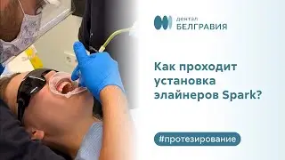 👄  Как проходит установка элайнеров Spark?