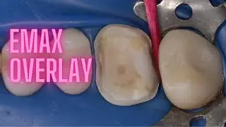 EMAX OVERLAY Blue provisional