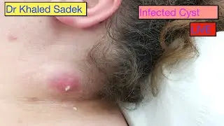 Head Cyst Compilation. Live. DR Khaled Sadek