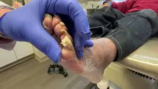 Unbelievable, long, painful toenails part 2!!