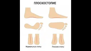 Что такое плоскостопие. Симптомы и что нужно делать