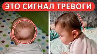 ТАКОЙ череп у малыша НЕ норма! / Чем ОПАСЕН плоский затылок у ребенка?