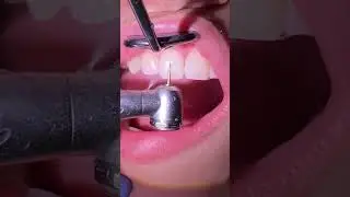 I'm getting my braces off   - Tooth Time Family Dentistry New Braunfels Texas 