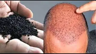 ये हैं वो इकलौती चीज जो गंजे सिर पर फिर से उगा सकती  है बाल 100% Effective Hair Regrowth Remedy