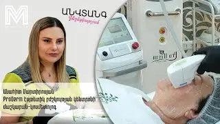 HIFU (SMAS lifting). դեմքի ապարատային ձգում,որը համարժեք է պլաստիկ վիրահատությանը #medmedia