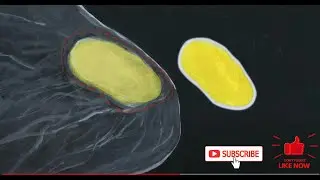 Phyllodes tumor rare breast cancer