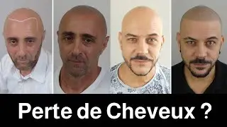 La technique parfaite pour moi: La Dermopigmentation des cheveux