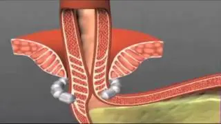 LINX Reflux Management System
