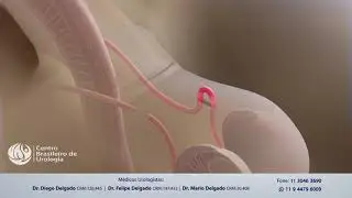 Cirurgia Vasectomia - Dr. Diego Delgado