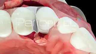 Vídeo 3D Preservación de papila modificada- Cortellini - Tráiler