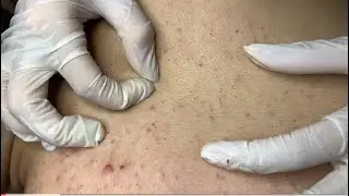 Remove blackheads on the back 