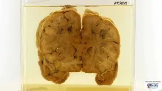 Brain: Fat embolism