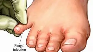 Sugat sa Paa at Alipunga - ni Dra Francisca Roa (Dermatologist) #7