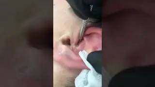 Самое залипательное видео давить прыщи Черные точки