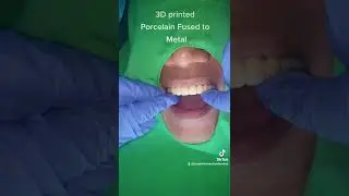 3D PRINTED PORCELAIN FUSED TO METAL CROWNS
