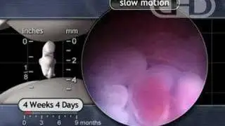 The Beating Heart in Slow Motion: 4 1/2 Weeks Pregnant
