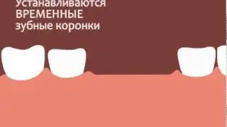 Бюгельный протез