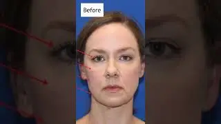Facelift Transformation! WOMAN LOOKS 15 YEARS YOUNGER!