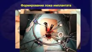 Лекция 3 Передние декомпрессивно стабилизирующие вмешательства,правка 2