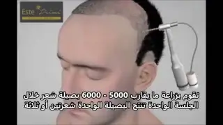 شرح مراحل زراعة الشعر بتقنية الاقتطاف Hair Transplant FUE how it work