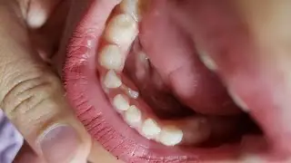 Quando o dente permanente nasce atrás do dente de leite