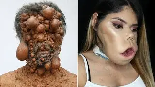 The rarest genetic mutations