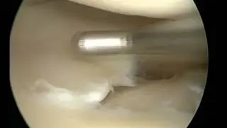 ПОПЕРЕЧНЫЙ РАЗРЫВ  ТЕЛА ЛАТЕРАЛЬНОГО  МЕНИСКА.