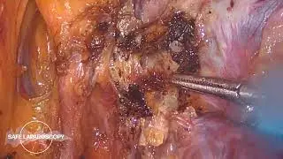Accidental ureteral transection during complex hystectomy