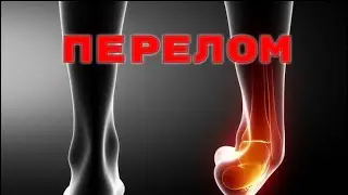 Что значит подвернул ногу?