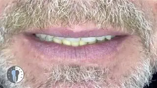 All on 4® – Patientenbeispiel | Zahnarztpraxis Dr. med. dent. Mustafa Ayna