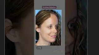 Forehead Reduction — Before & After