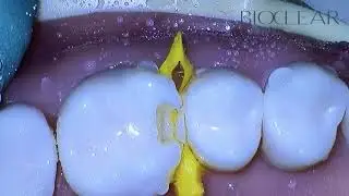 Bioclear Matrix | The Bioclear Class II Prep using Komet Burs
