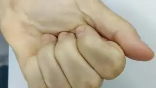 Лечение щелкающего пальца( Болезнь Нотта) без разрезов