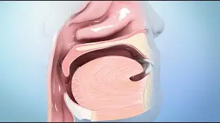 Qué es el Cáncer de Cabeza y Cuello