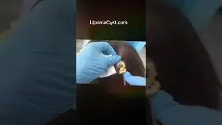 #skincare LIPOMACYST with Dr khaled sadek