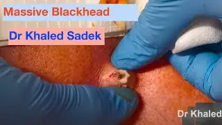 Massive Blackhead Removed. Dr Khaled Sadek. Www.lipomacyst.com