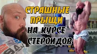Страшные прыщи на курсе стероидов
