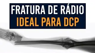 Caso clínico: fratura de rádio