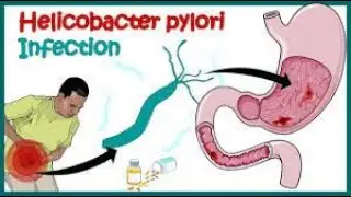H Pylori Infection | Gastric ulcer | Causes, Signs and Symptoms, Diagnosis and Treatment.||Dr Najid