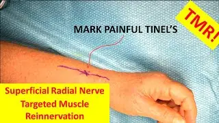 Targeted Muscle Re-innervation (TMR) for Superficial Radial Nerve Neuroma