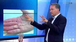 Behandlung von Morbus Dupuytren